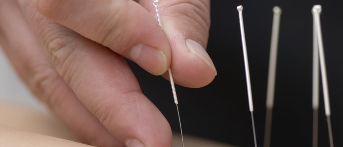 Achieve optimal health and wellbeing with dry needling in 1 hour treatment